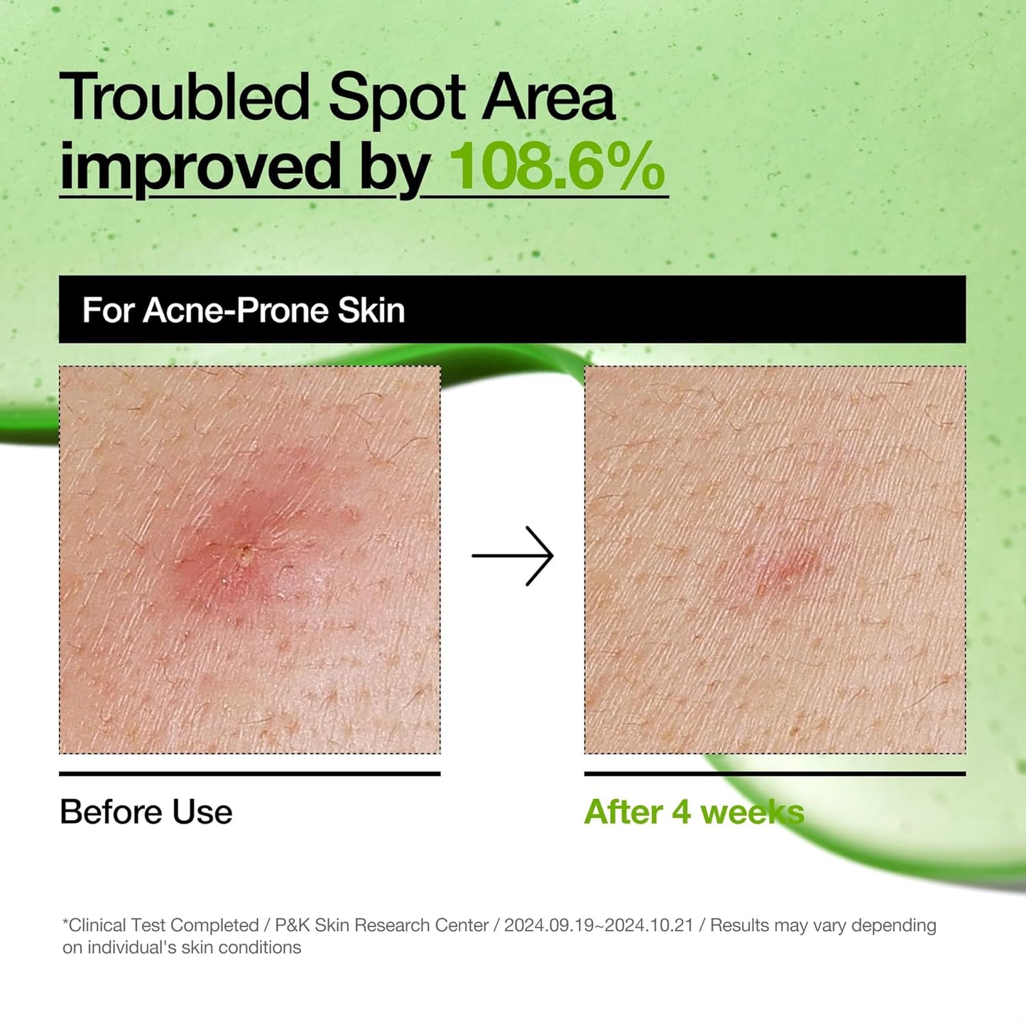 Anua Azelaic Acid 10+ Hyaluron Redness Soothing Serum