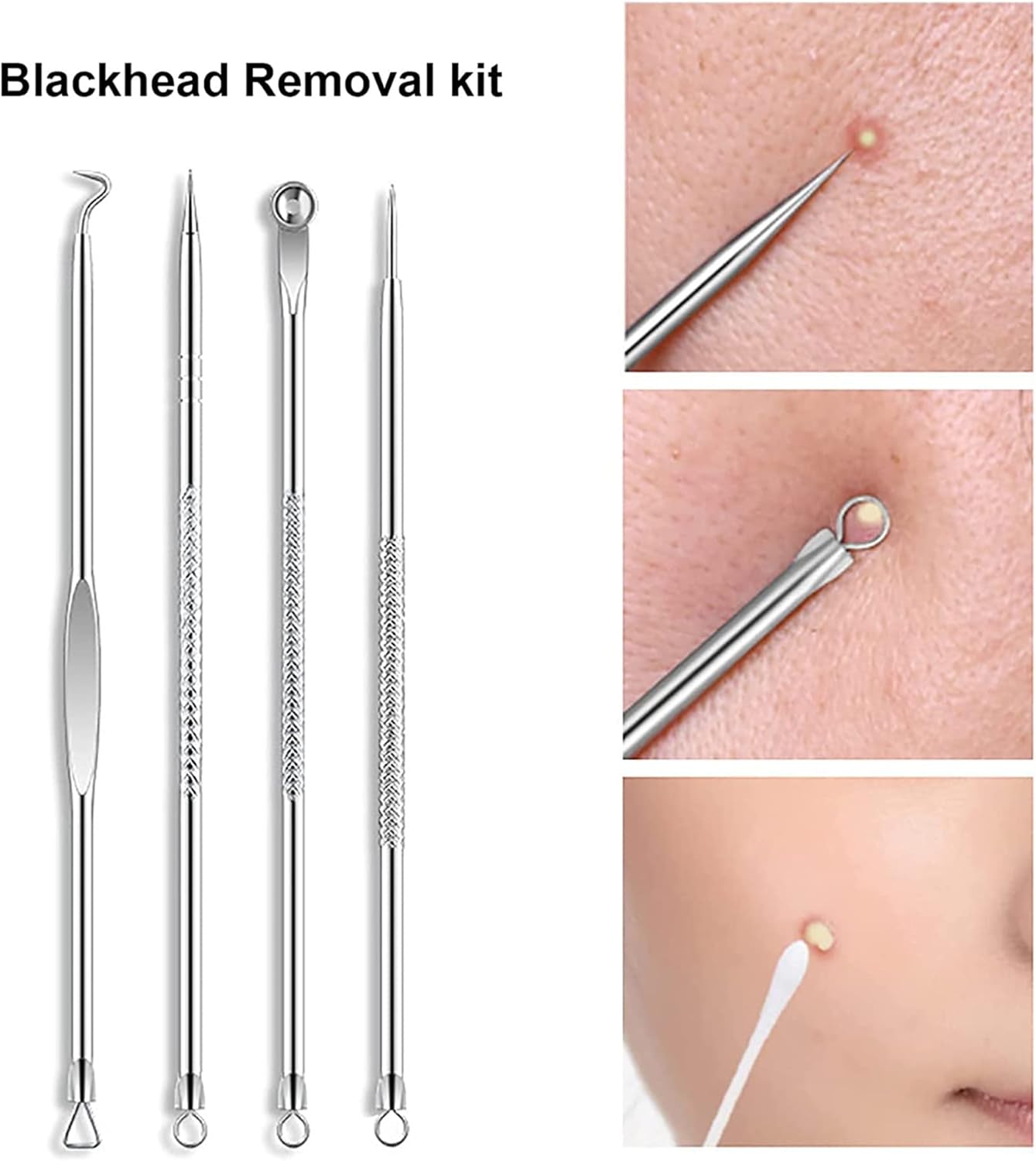 Blackhead Removal Kit – 4-in-1 Stainless Steel Extractor Set
