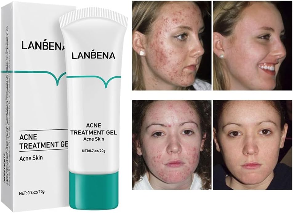 Lanbena Acne Treatment Gel – Clear, Calm & Restore