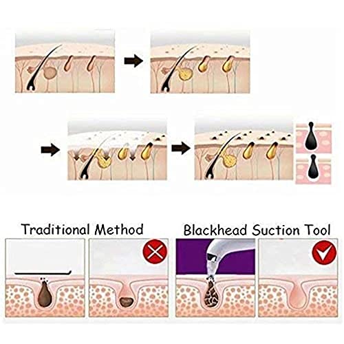 DermaSuction Pore Cleaning Device