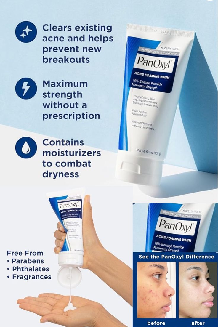 PanOxyl Acne Foaming Wash – 10% Benzoyl Peroxide (Maximum Strength)